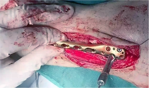 TIBIAL PLATEAU LEVELLING OSTEOTOMY-TPLO